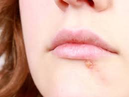 herpes cure herpes naturally