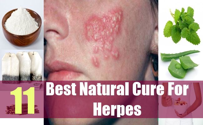 herpes can be naturally cured