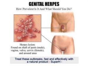 hsv1-and-hsv2 herpes cure 2017