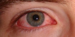 eye herpes treatment
