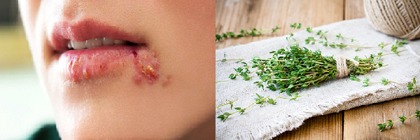 thyme oil for herpes outbreaks